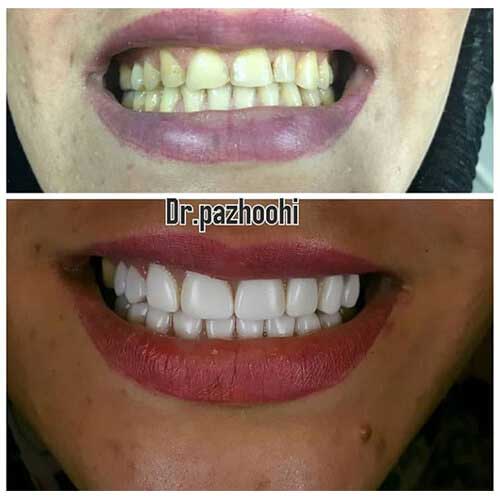نمونه کار زیبایی و فیسینگ دندان در کلینیک دندانپزشکی بهاران