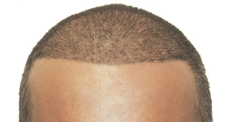بهترین روش کاشت مو چیست؟