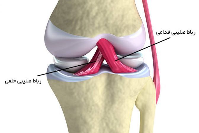 پارگی رباط صلیبی قدامی در مفصل زانو
