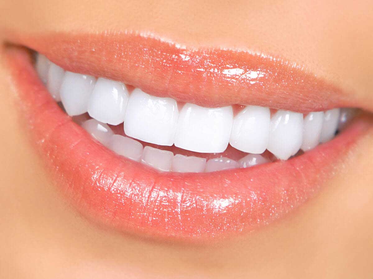لمینت سرامیکی دندان یا لمینت کریستالی لمینت سرامیکی دندان یا لمینت کریستالی