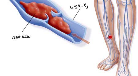 عوامل خطرناک و تشدید کننده لخته شدن خون عوامل خطرناک و تشدید کننده لخته شدن خون