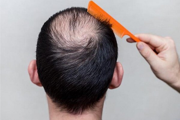 اثرات منفی شغل بر مو و نکات مهم ریزش مو