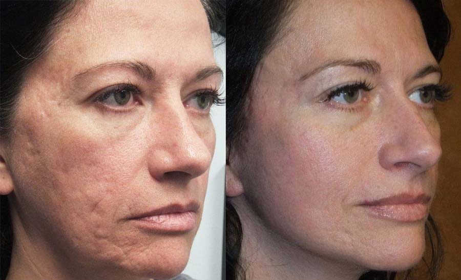 سابسیژن چیست؟