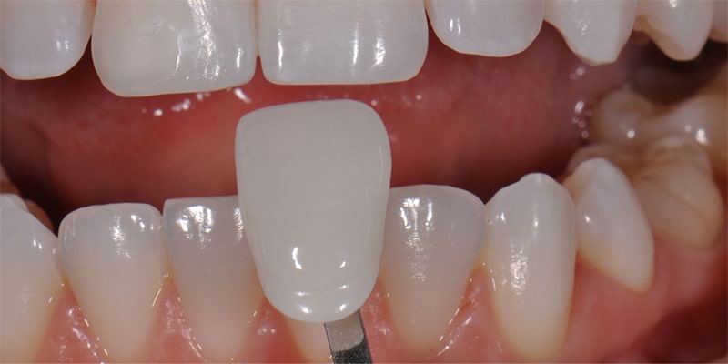 معایب و عوارض لمینت دندان