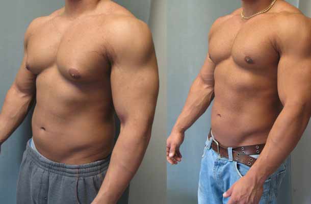 چگونگی جراحی ژنیکوماستی