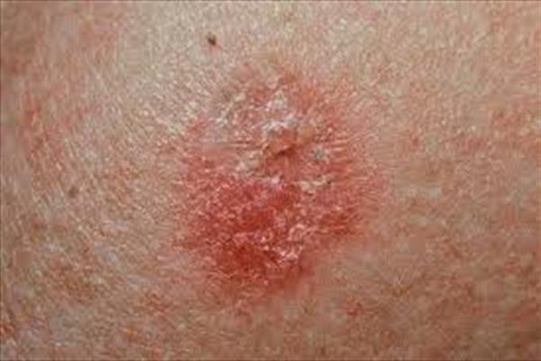 خطرات تهدید کننده ناشی از سرطان پوست