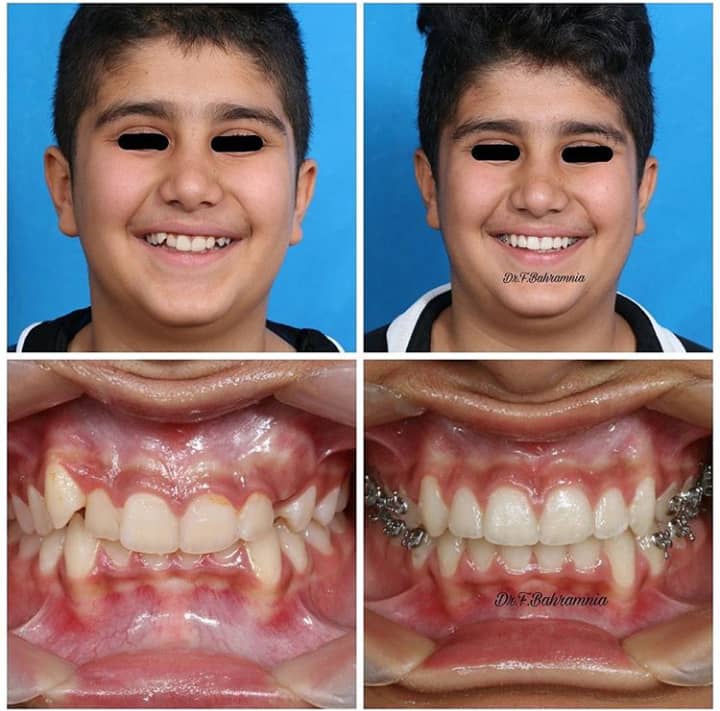 نمونه کار ارتودنسی در کلینیک دندانپزشکی بهاران