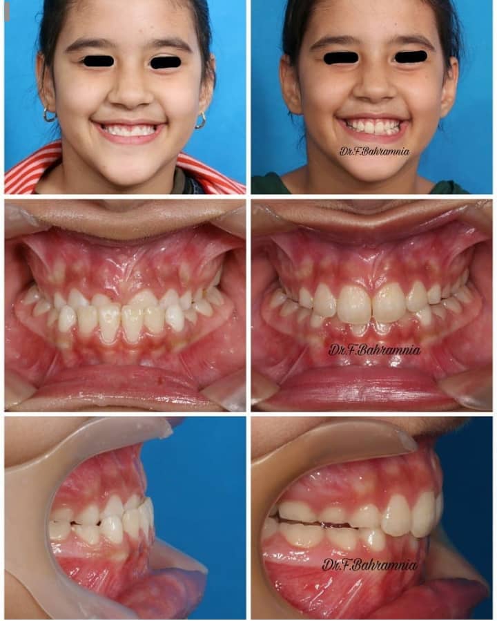 نمونه کار ارتودنسی در کلینیک دندانپزشکی بهاران