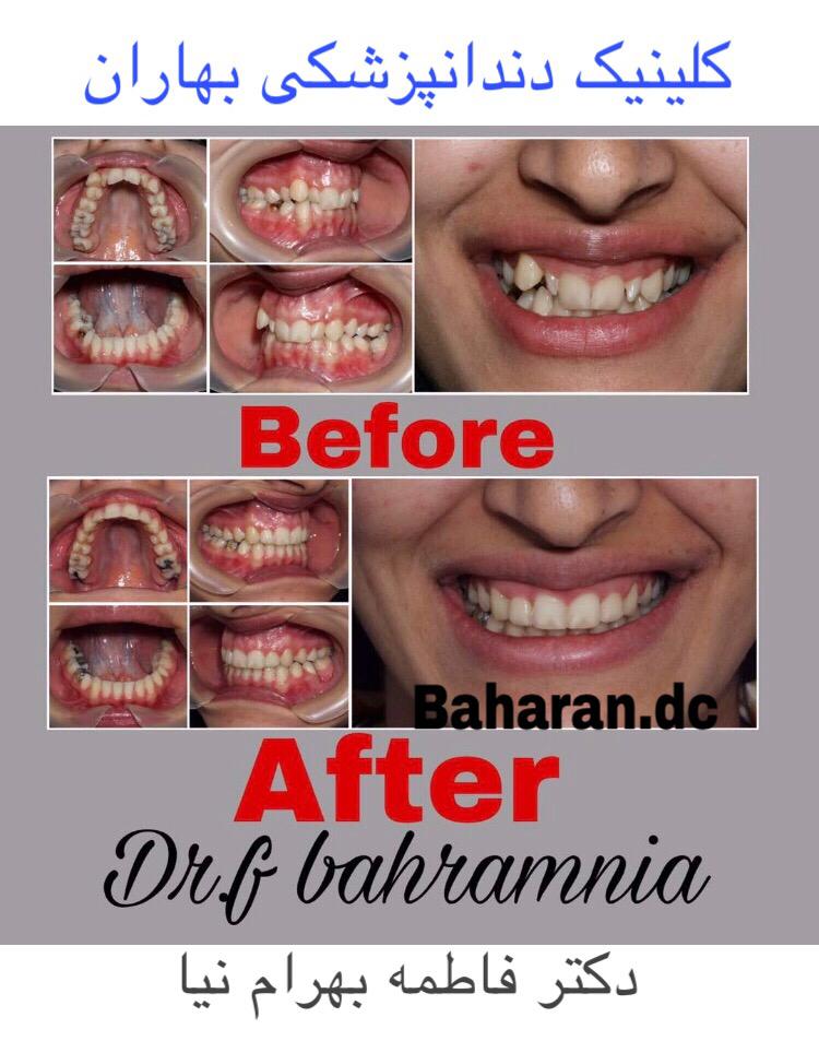 نمونه کار ارتودنسی در کلینیک دندانپزشکی بهاران