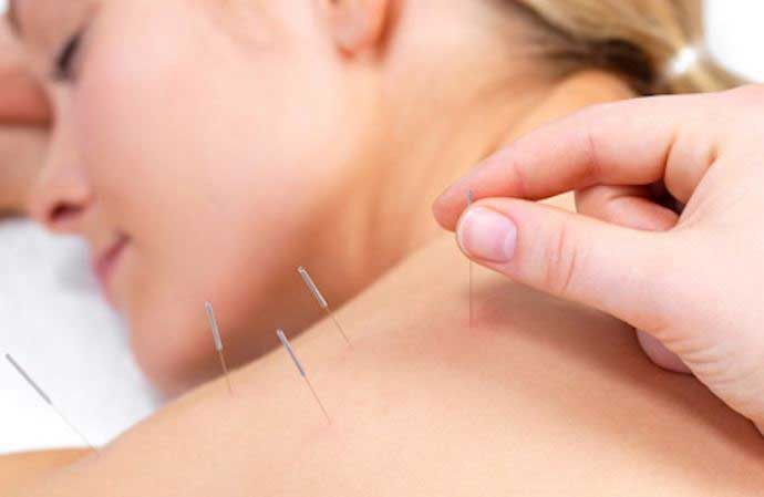 طب سوزنی چیست و برای درمان چه بیماری هایی استفاده می شود؟ طب سوزنی چیست و برای درمان چه بیماری هایی استفاده می شود؟