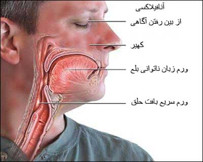 علل و علائم بیماری آنافيلاكسی ( شوک آلرژیک ) علل و علائم بیماری آنافيلاكسی ( شوک آلرژیک )