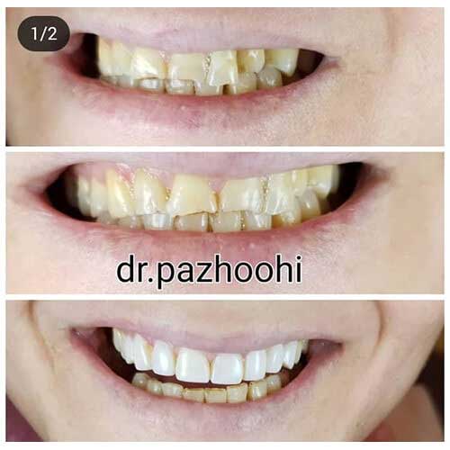 نمونه کار زیبایی و فیسینگ دندان در کلینیک دندانپزشکی بهاران
