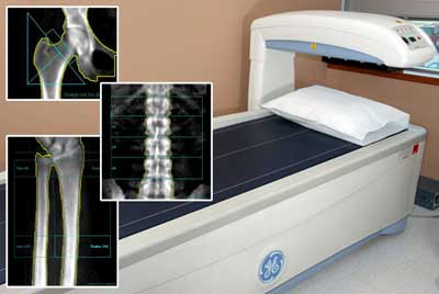 سنجش تراکم استخوان یا دانسیتومتری چگونه است؟ سنجش تراکم استخوان یا دانسیتومتری چگونه است؟