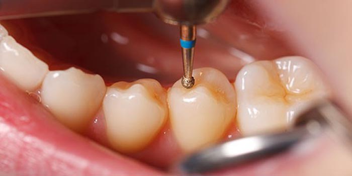 همه چیز درباره سن و عوارض پوسیدگی و پرکردن دندان