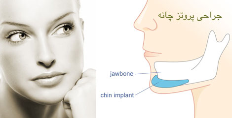 همه چیز در مورد جراحی پروتز چانه