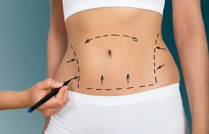 قبل از ابدومینوپلاستی چه باید کرد؟